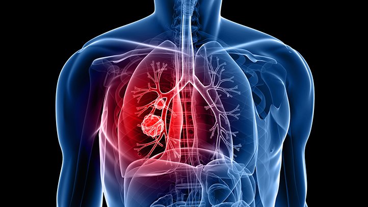 https://www.everydayhealth.com/lung-cancer/easing-pain-of-lung-cancer.aspx